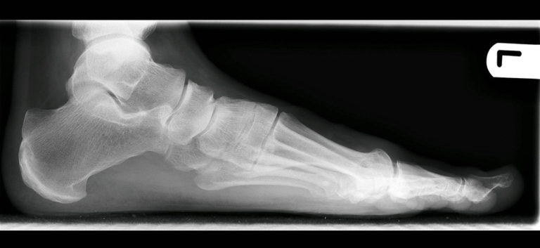 flat foot treatment
